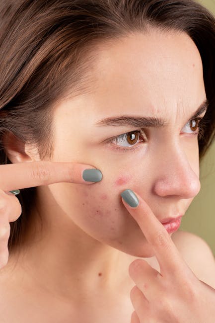 Why Adults Get Acne